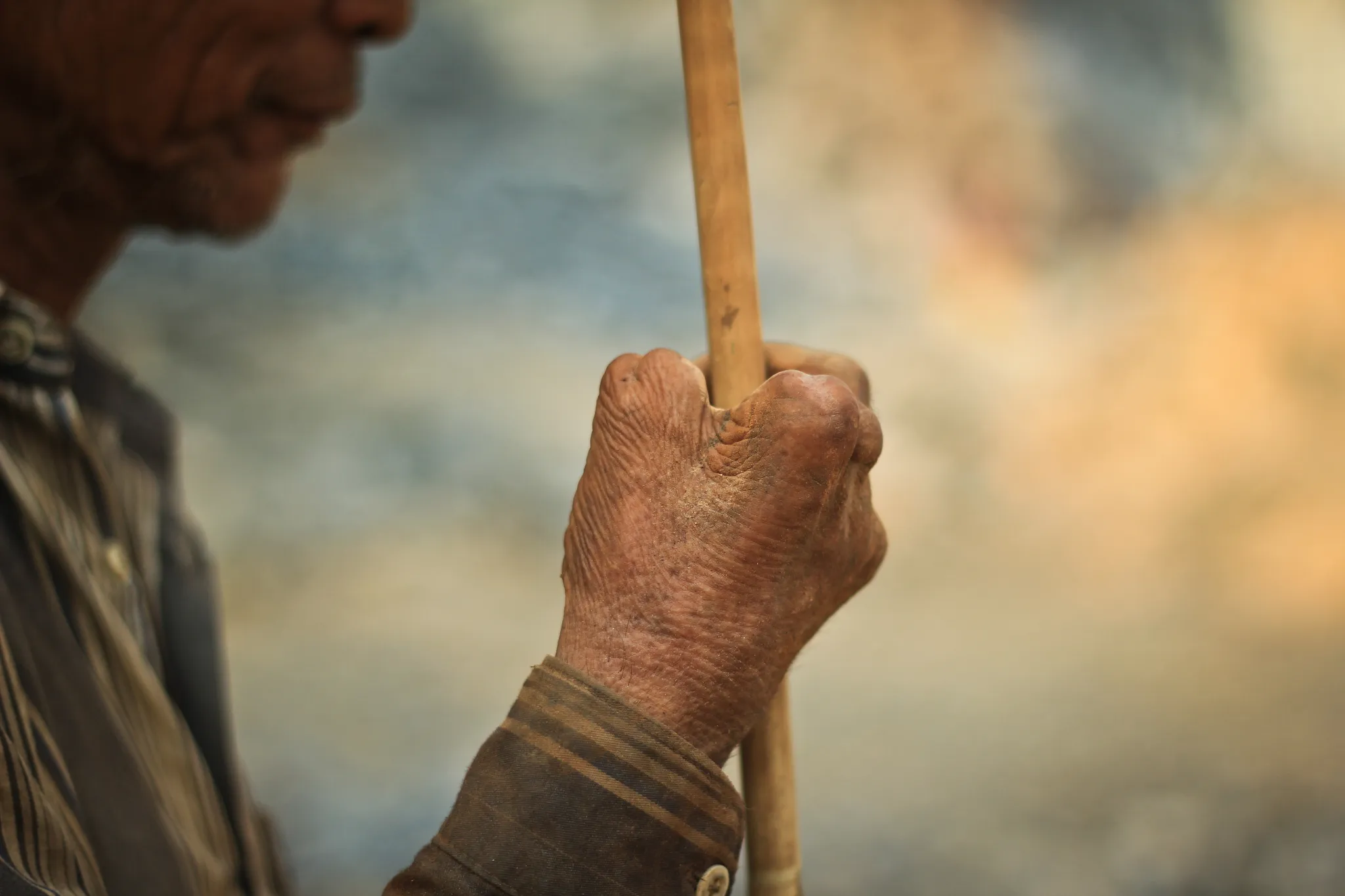 The man lost his figers after the explosive accident. Image credit: Myanmar Project Collective - Visualrebellion.org